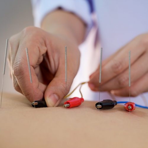 electro-acupuncture-traditional-chinese-acupuncture-electro-acupuncture-body-patient