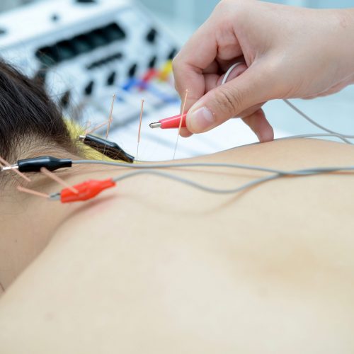 Electro Acupuncture.Traditional Chinese acupuncture and Electroacupuncture on body of patient