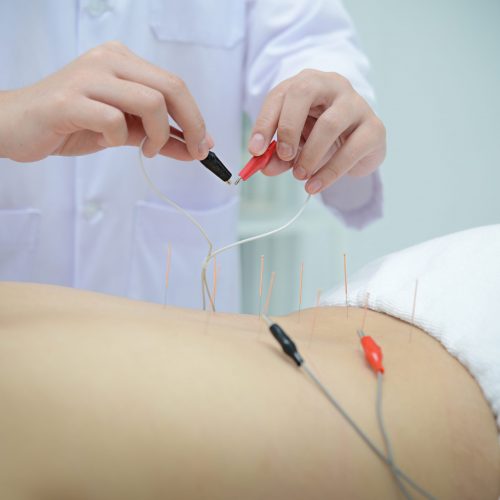 Electro Acupuncture.Traditional Chinese acupuncture and Electroacupuncture on body of patient