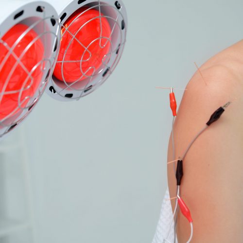 Electro Acupuncture.Traditional Chinese acupuncture and Electroacupuncture on body of patient