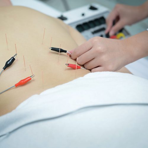 Electro Acupuncture.Traditional Chinese acupuncture and Electroacupuncture on body of patient